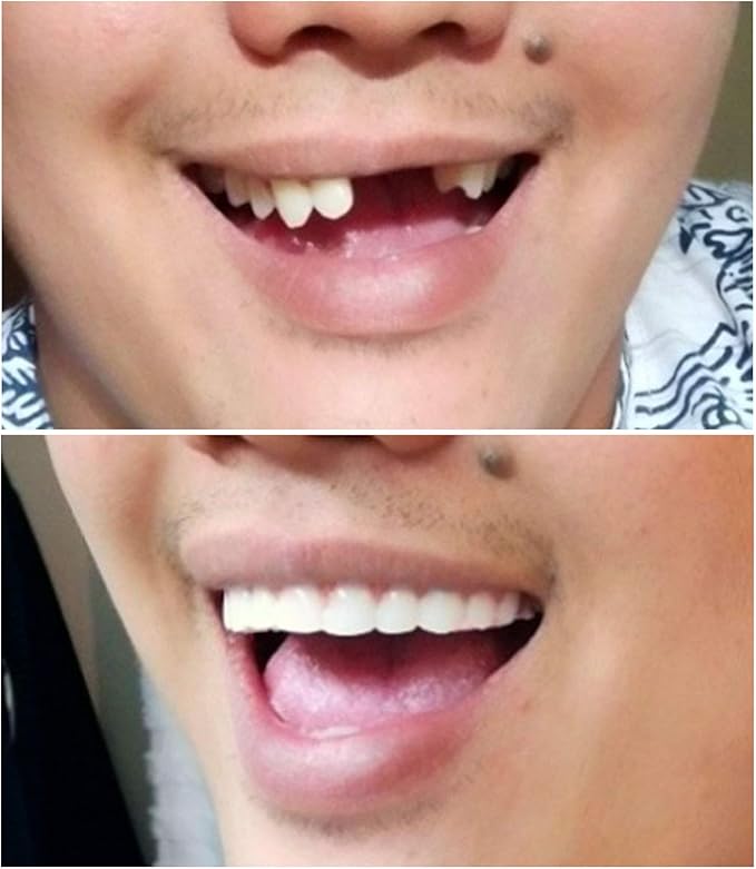 Instant Smile Comfort Fit Flex Upper Veneers 2 shades