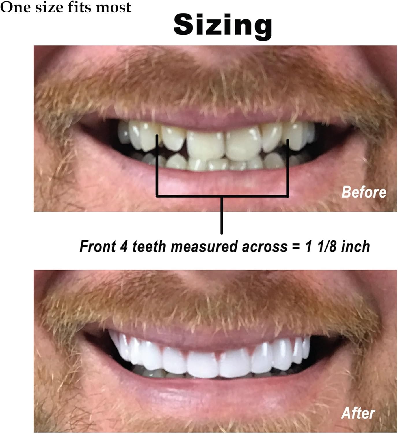 Instant Smile Comfort Fit Flex Upper Veneers 2 shades