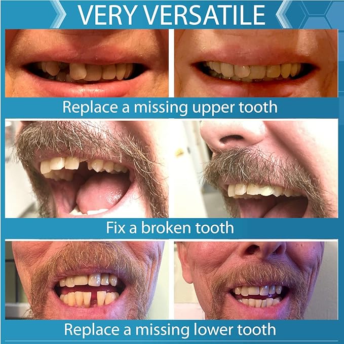 Instant Smile Complete Your Smile Temporary Tooth Replacement Kit